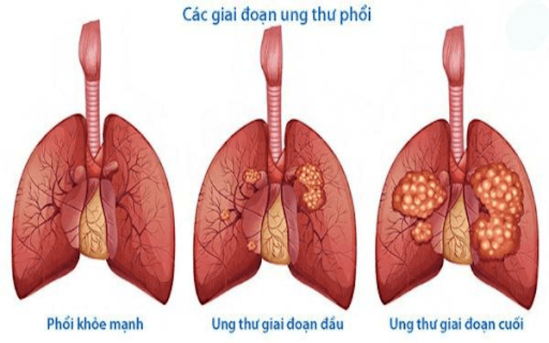 Dấu hiệu ung thư phổi giai đoạn cuối